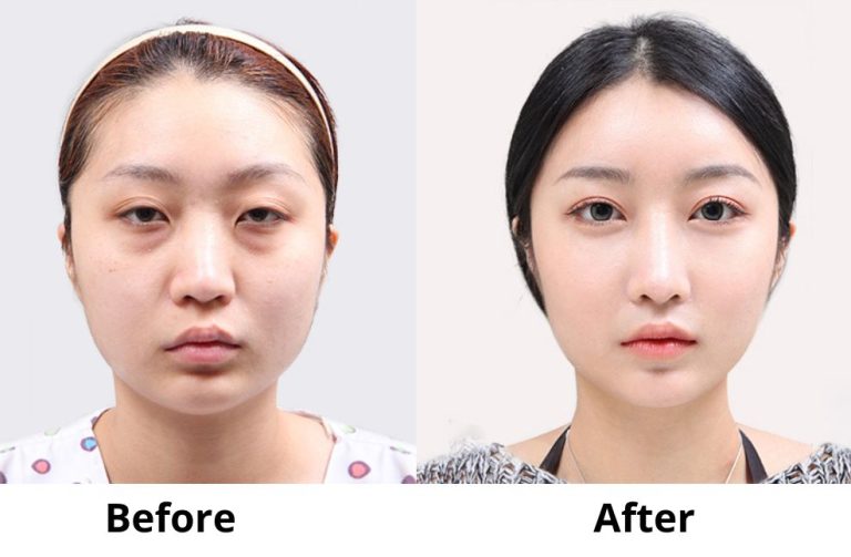 67610b9e274a9abc65cb51ef_67610b96be9aa0e6d8b84ca3_eyelid20inkorea