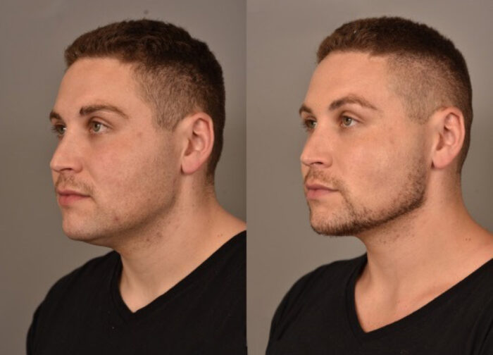 RS_BuccalFat-700x504