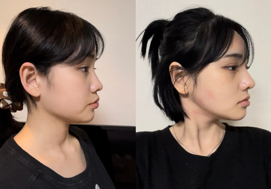 Square_Jaw_Surgery_Before_after_10113020_127919